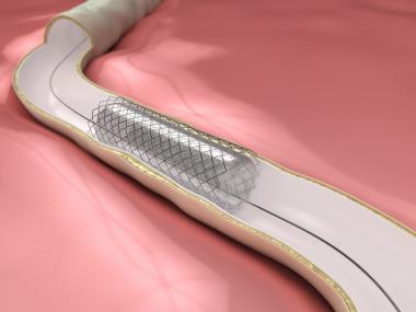 Gefährliche Therapie bei Schlaganfällen: Stents vervierfachen Ihr Rückfallrisiko